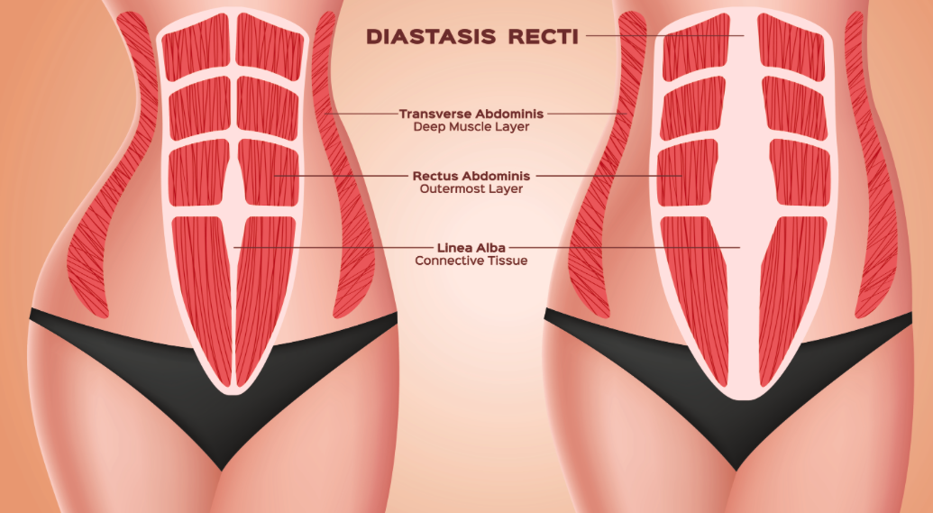 Different types of Diastasis. Diastasis in a woman after pregnancy